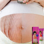 Stretch-Marks-Remover-Cream.jpg