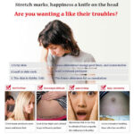 Stretch-Marks-Remover-Cream.jpg